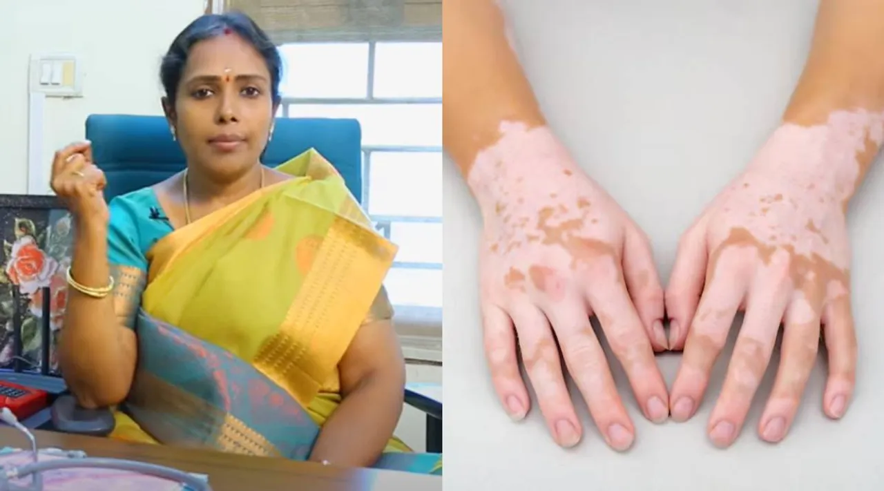 Dr Rajalakshmi vitiligo